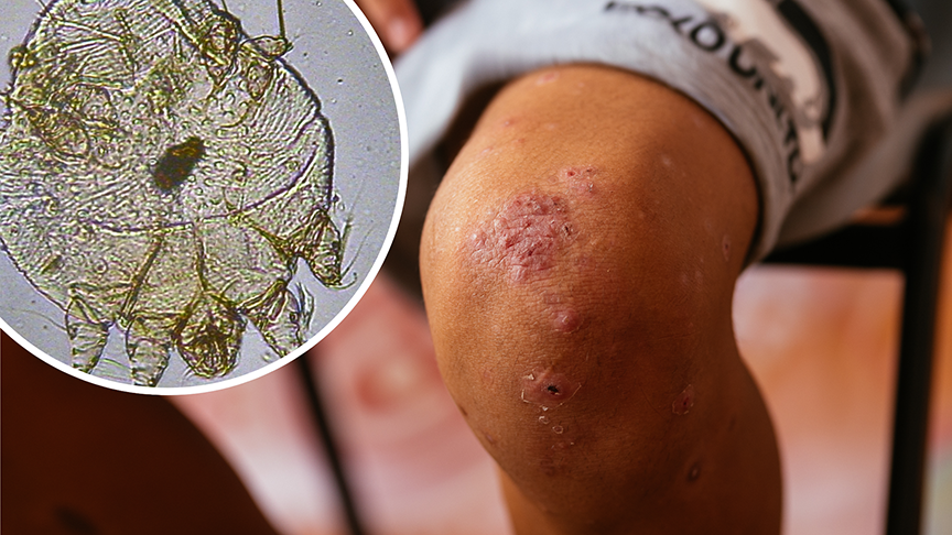 Close-up image of scabies rash on a patient’s knee including inset of magnified human scabies mite