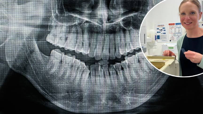 X-ray of mouth with inset of smiling woman holding x-ray plate up to machine